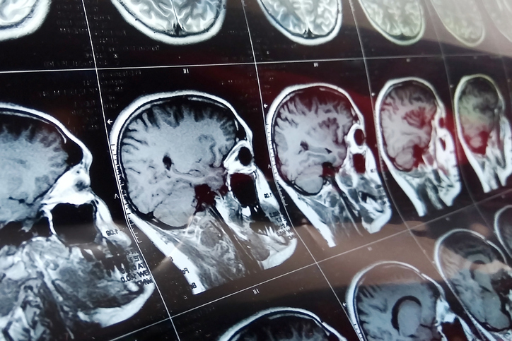 mri scan showing traumatic brain injury